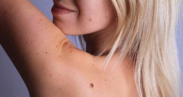 Dermatology
