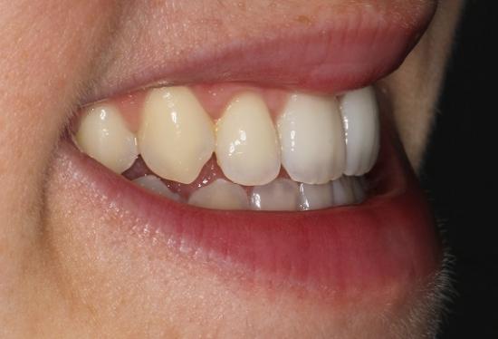 Adult treatment with Incognito braces : 6 months to close the gap